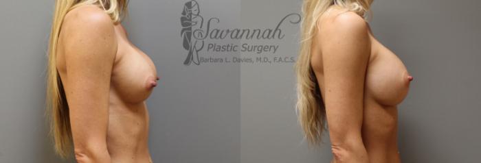 Before & After Implant Exchange Case 1 View 2 View in Savannah, Georgia