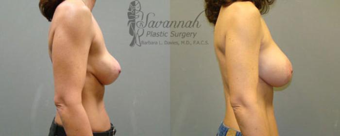 Before & After Implant Exchange Case 14 View 2 View in Savannah, Georgia