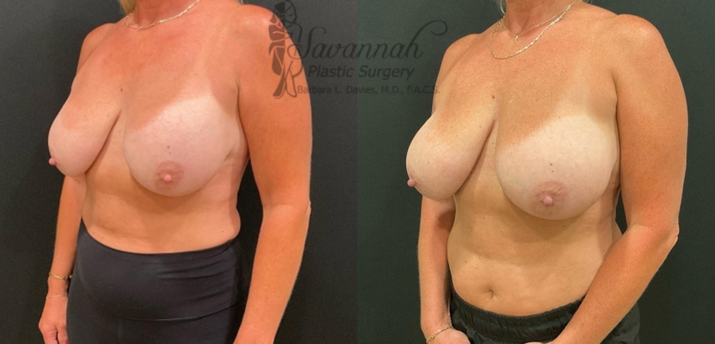 Before & After Implant Exchange Case 86 Right Oblique View in Savannah, Georgia