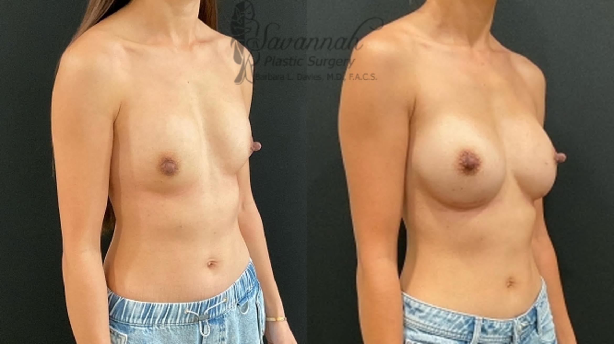 Before & After Implant Exchange Case 91 Right Oblique View in Savannah, Georgia