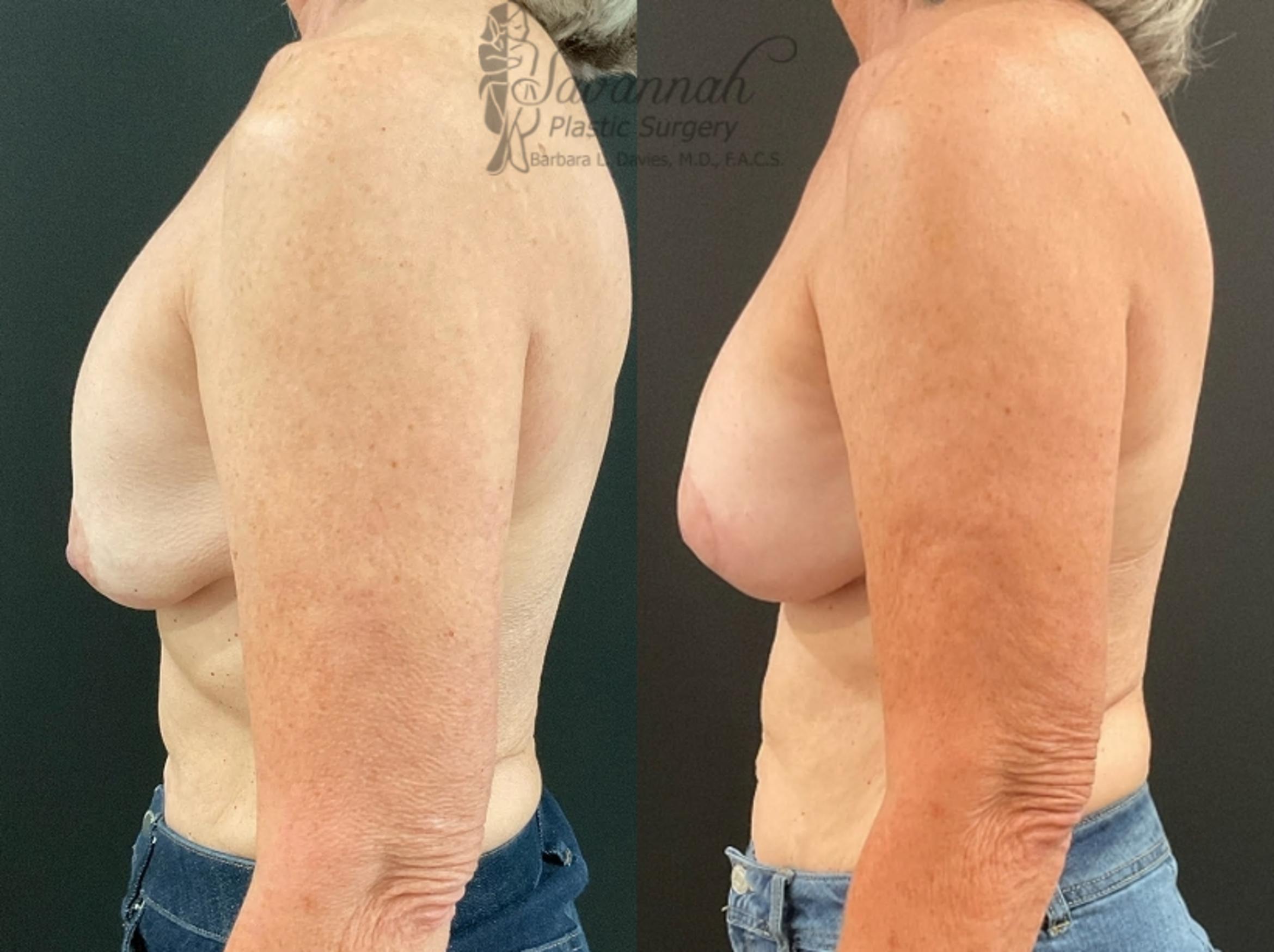 Before & After Implant Exchange Case 92 Left Side View in Savannah, Georgia