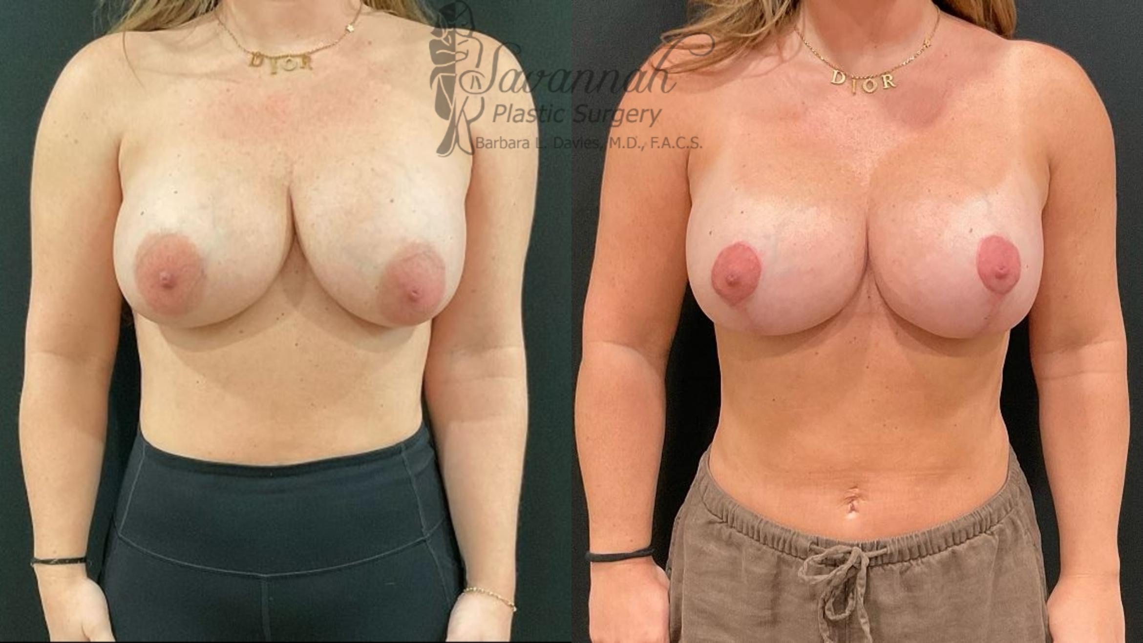 Before & After Implant Exchange Case 98 Front View in Savannah, Georgia