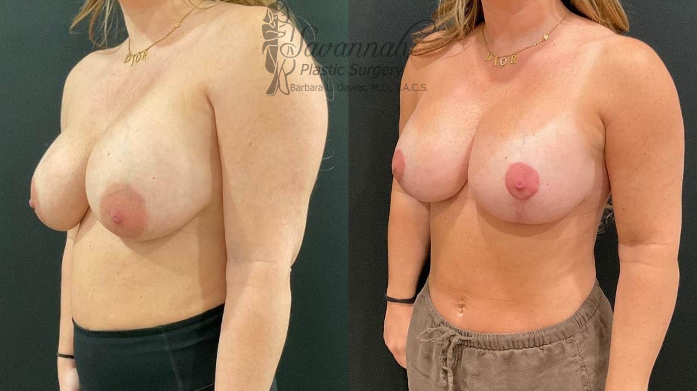 Before & After Implant Exchange Case 98 Left Oblique View in Savannah, Georgia