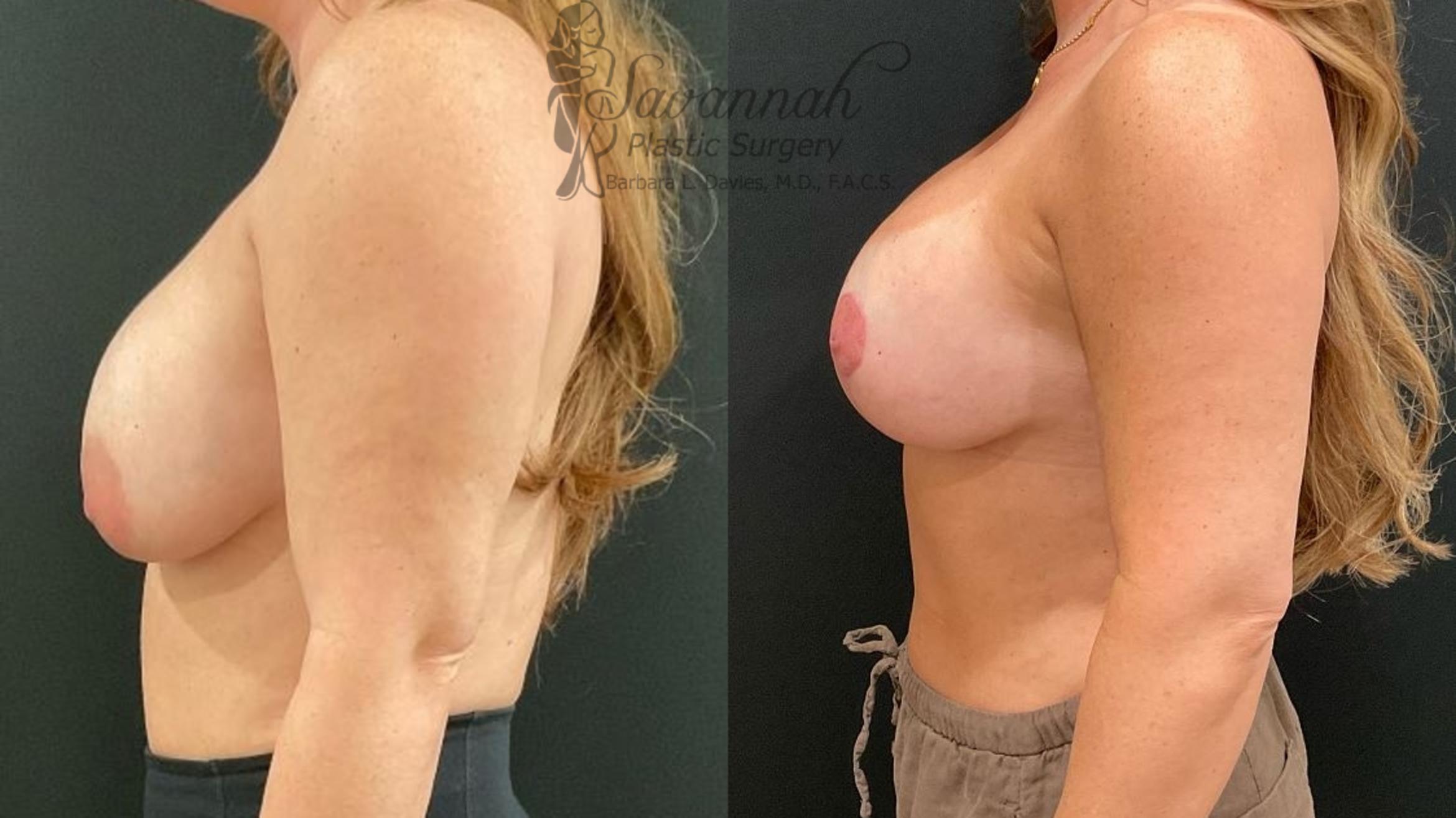 Before & After Implant Exchange Case 98 Left Side View in Savannah, Georgia