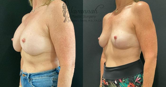 Before & After Implant Removal Case 89 Left Oblique View in Savannah, Georgia