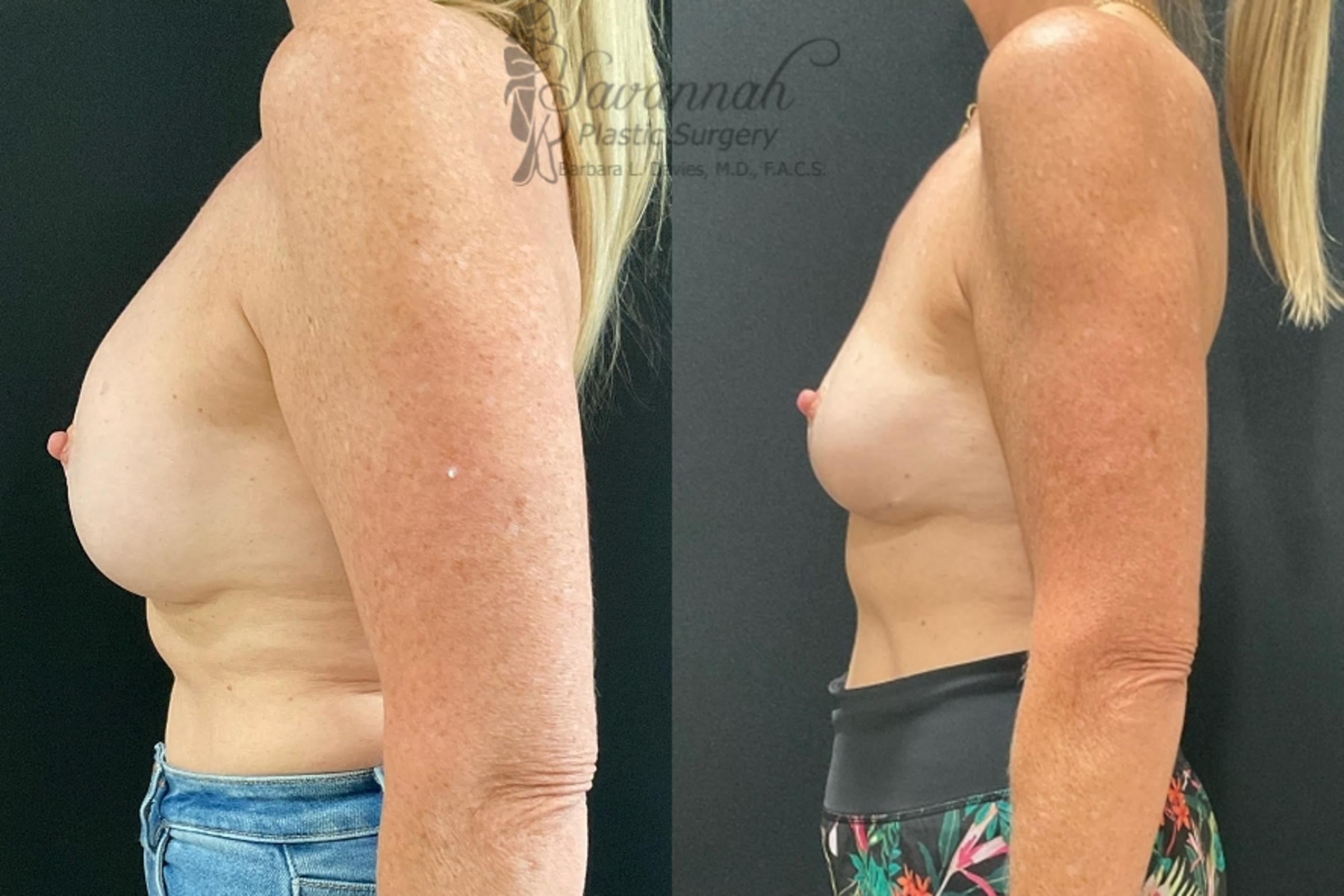 Before & After Implant Removal Case 89 Left Side View in Savannah, Georgia