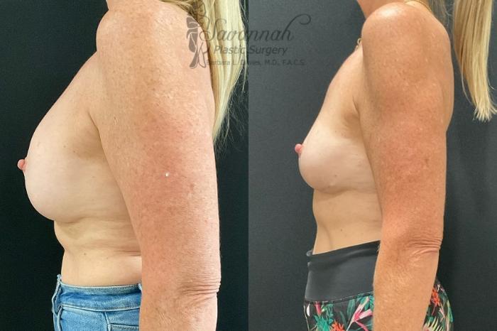 Before & After Implant Removal Case 89 Left Side View in Savannah, Georgia