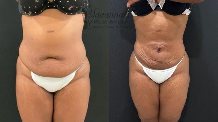Before & After Liposuction Case 102 Front View in Savannah, Georgia