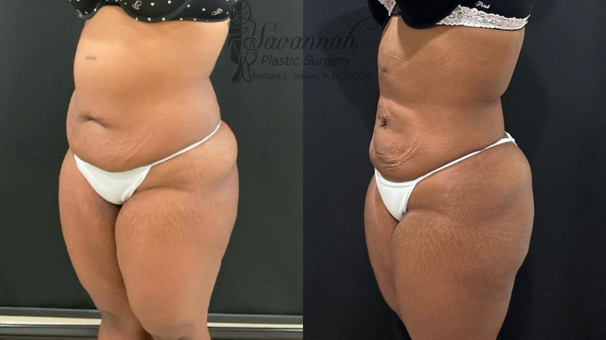 Before & After Liposuction Case 102 Left Oblique View in Savannah, Georgia