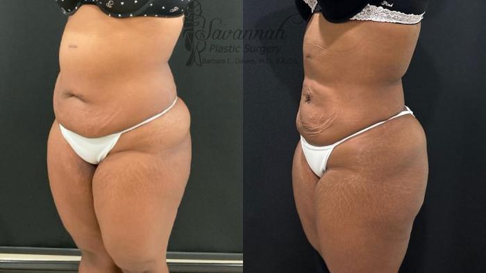 Before & After Liposuction Case 102 Left Oblique View in Savannah, Georgia