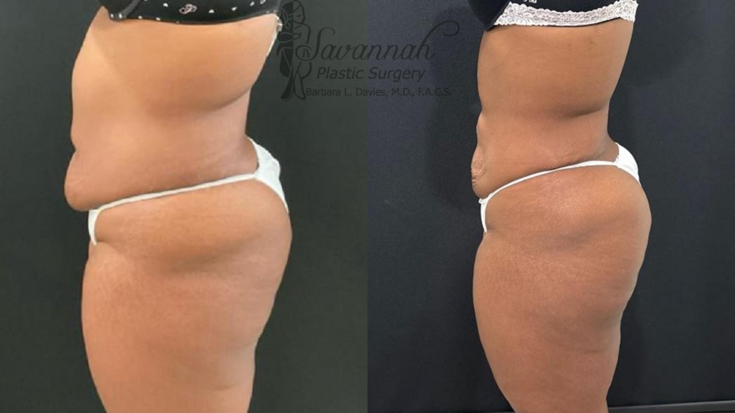 Before & After Liposuction Case 102 Left Side View in Savannah, Georgia