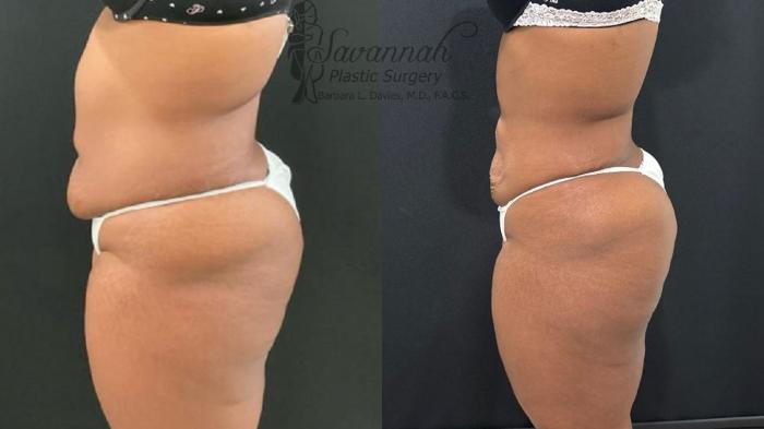 Before & After Liposuction Case 102 Left Side View in Savannah, Georgia