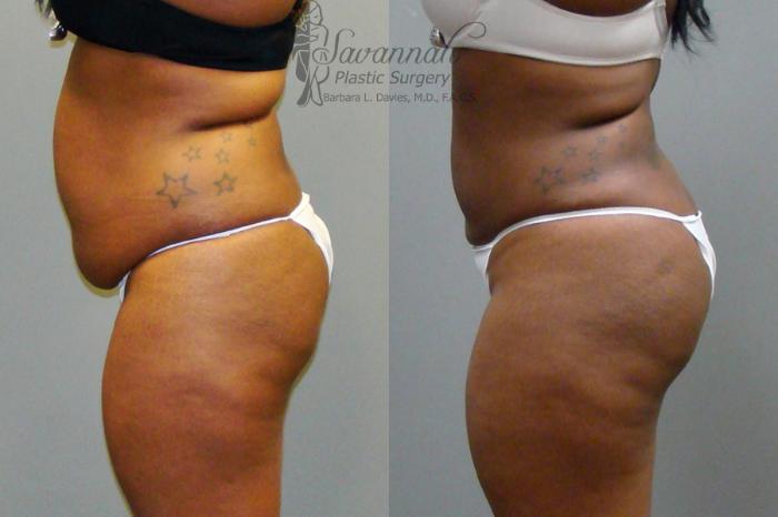 Before & After Liposuction Case 44 View 2 View in Savannah, Georgia