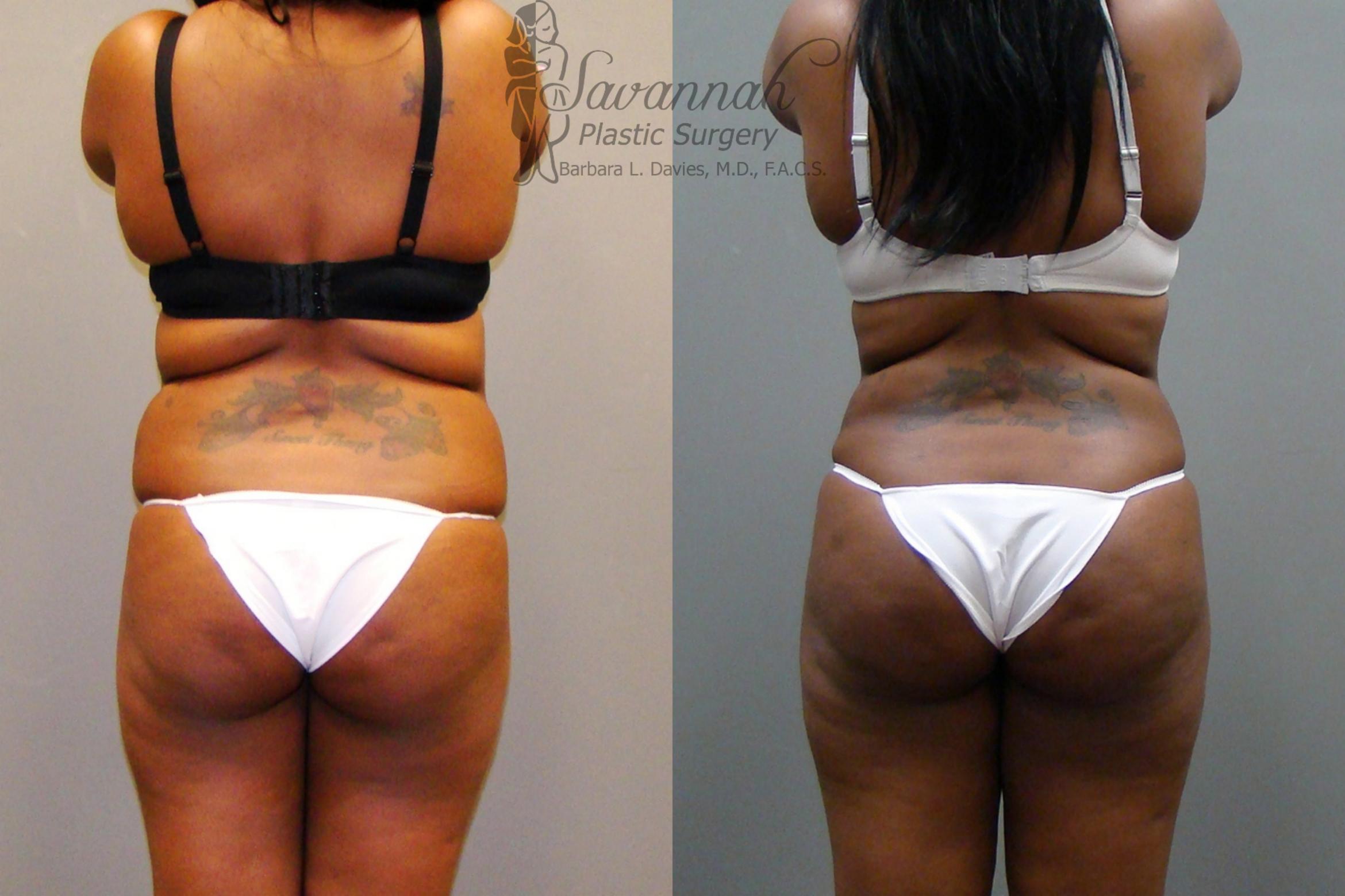 Before & After Liposuction Case 44 View 3 View in Savannah, Georgia