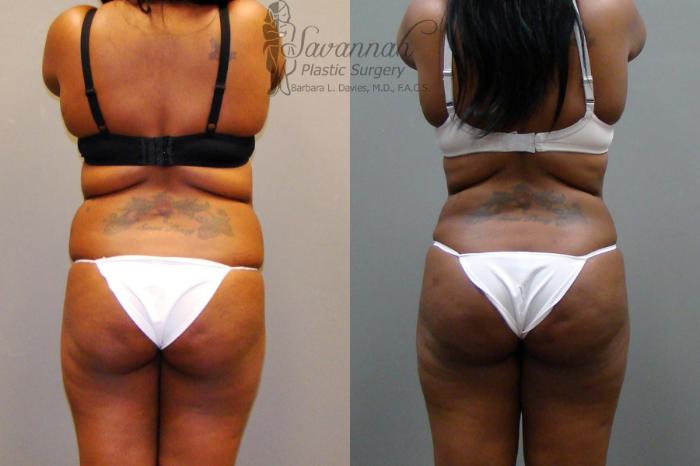 Before & After Liposuction Case 44 View 3 View in Savannah, Georgia