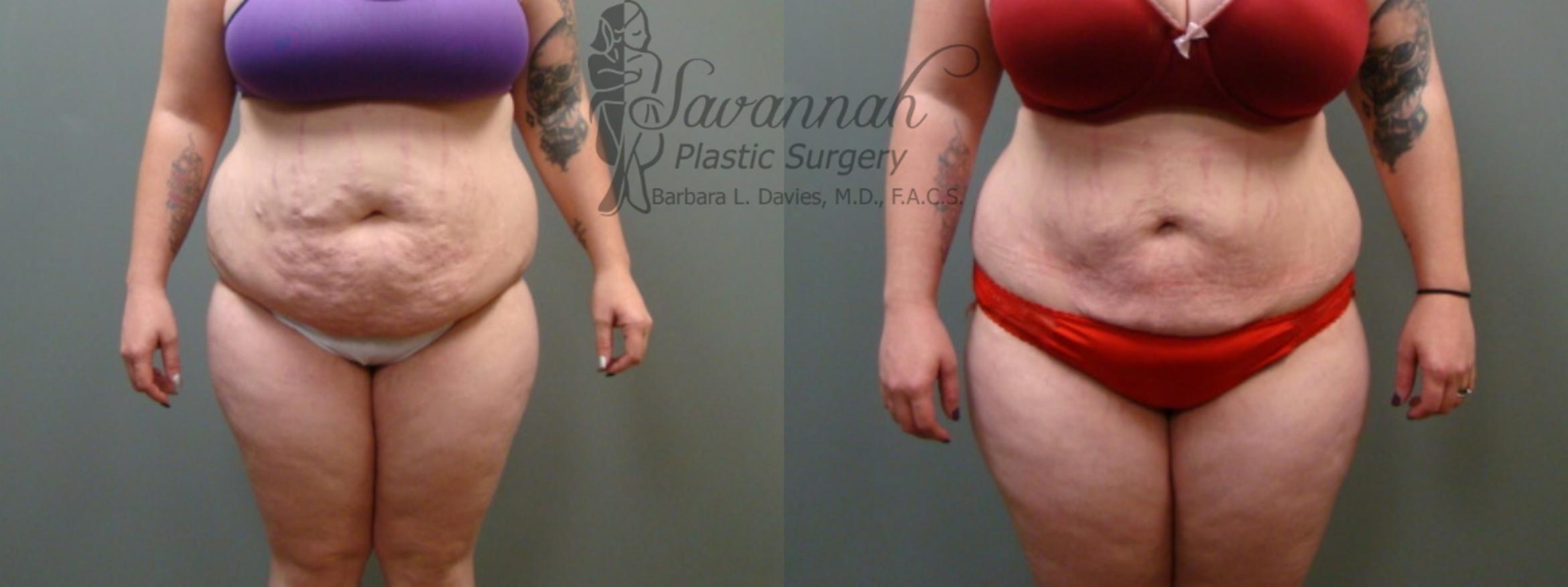 Before & After Liposuction Case 45 View 1 View in Savannah, Georgia