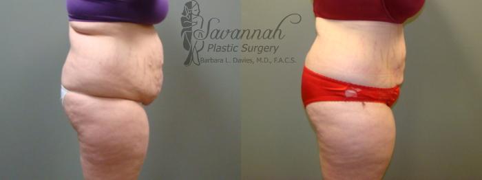 Before & After Liposuction Case 45 View 2 View in Savannah, Georgia