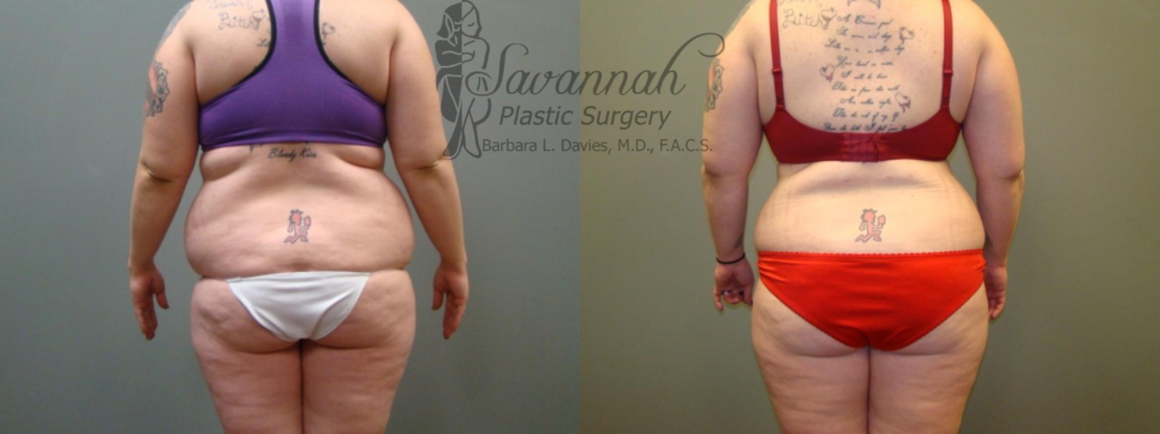 Before & After Liposuction Case 45 View 3 View in Savannah, Georgia