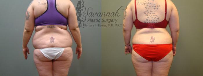 Before & After Liposuction Case 45 View 3 View in Savannah, Georgia