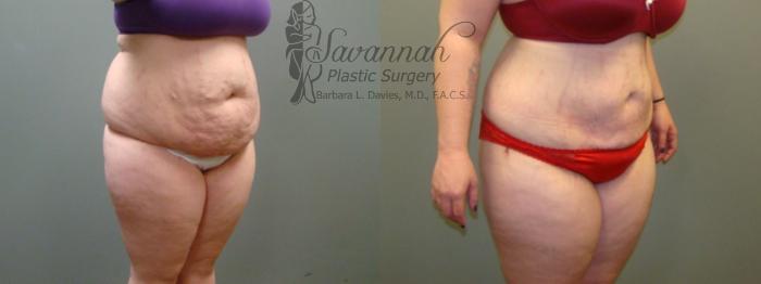 Before & After Liposuction Case 45 View 4 View in Savannah, Georgia