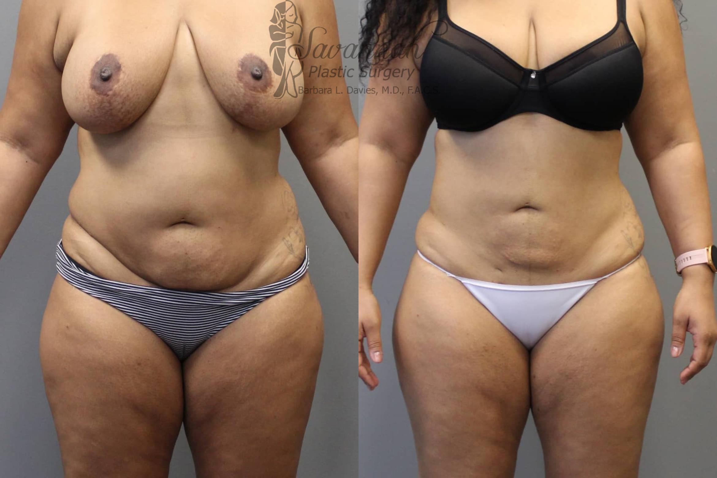 Before & After Liposuction Case 47 View 1 View in Savannah, Georgia