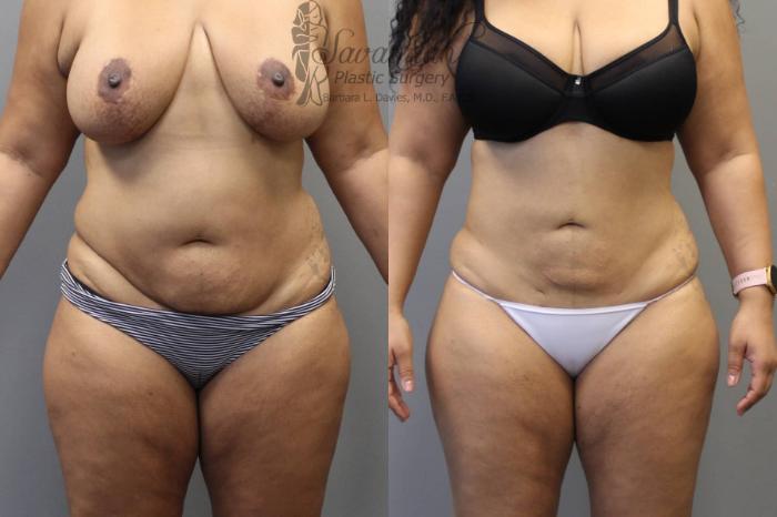Before & After Liposuction Case 47 View 1 View in Savannah, Georgia