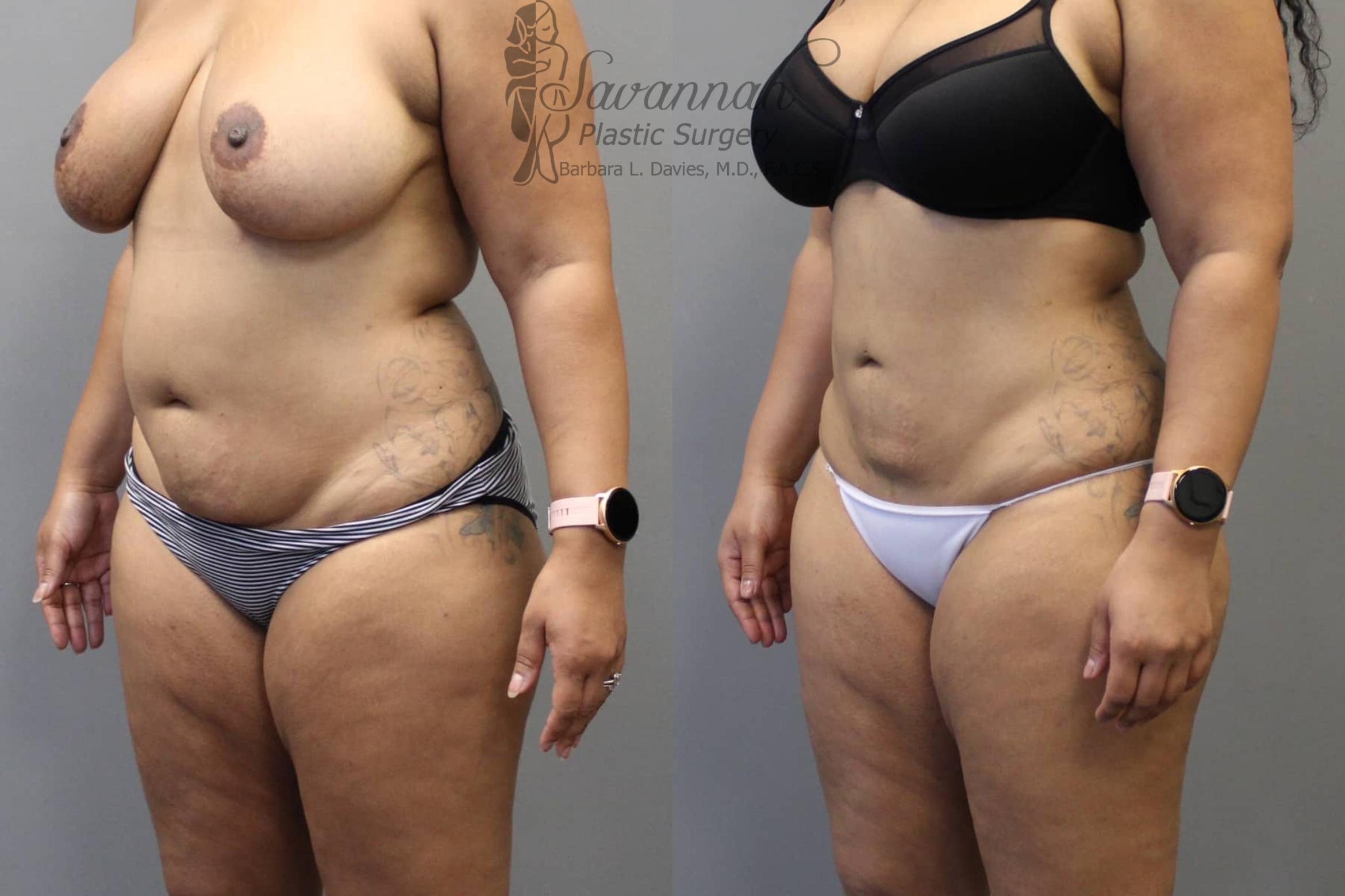 Before & After Liposuction Case 47 View 2 View in Savannah, Georgia