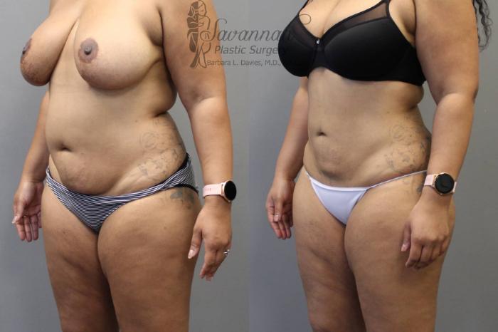 Before & After Liposuction Case 47 View 2 View in Savannah, Georgia