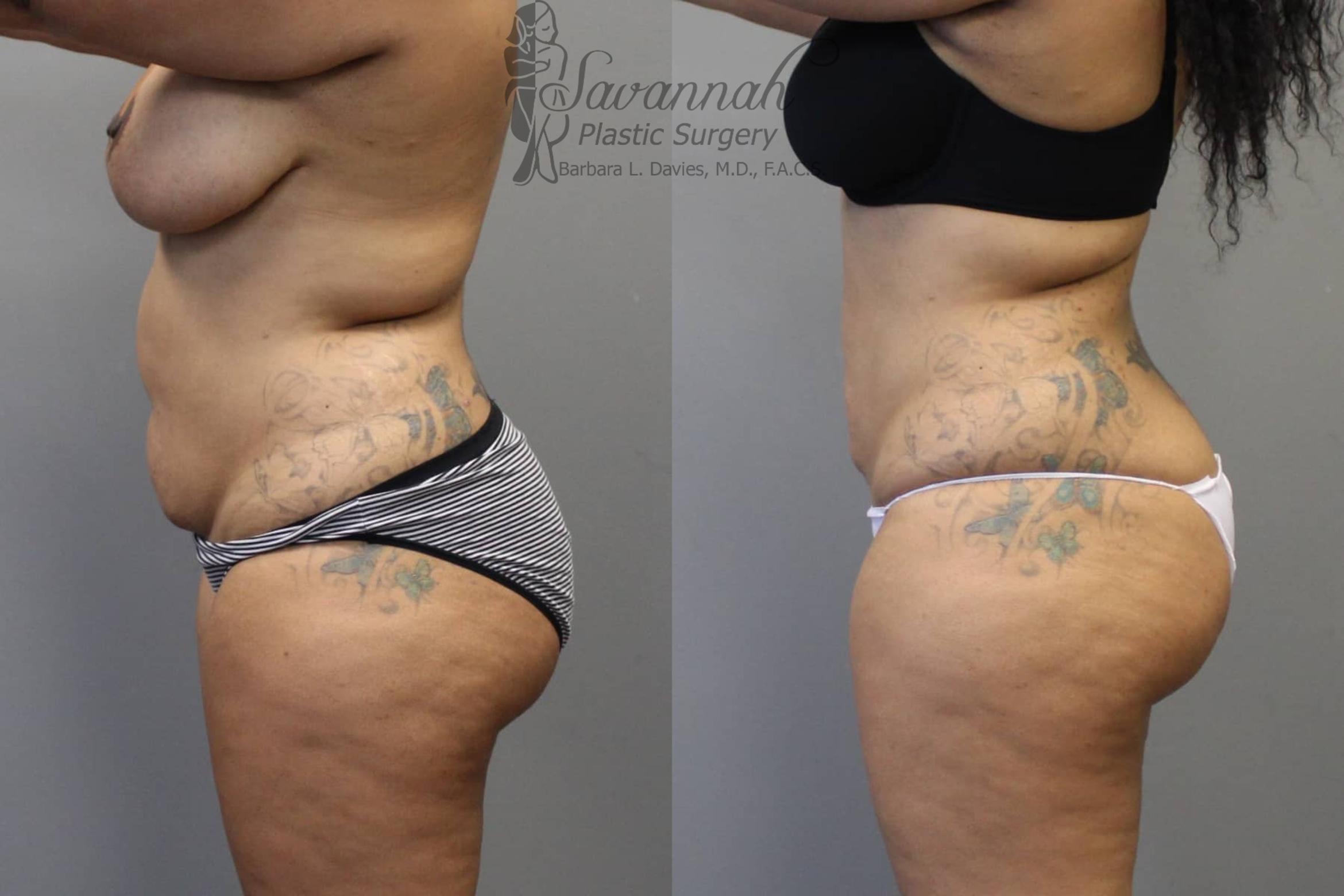 Before & After Liposuction Case 47 View 3 View in Savannah, Georgia