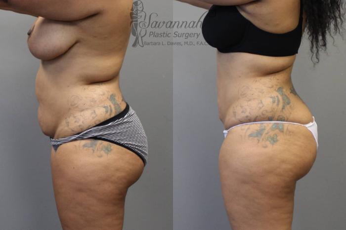 Before & After Liposuction Case 47 View 3 View in Savannah, Georgia