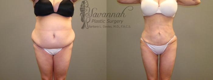 Before & After Liposuction Case 48 View 1 View in Savannah, Georgia