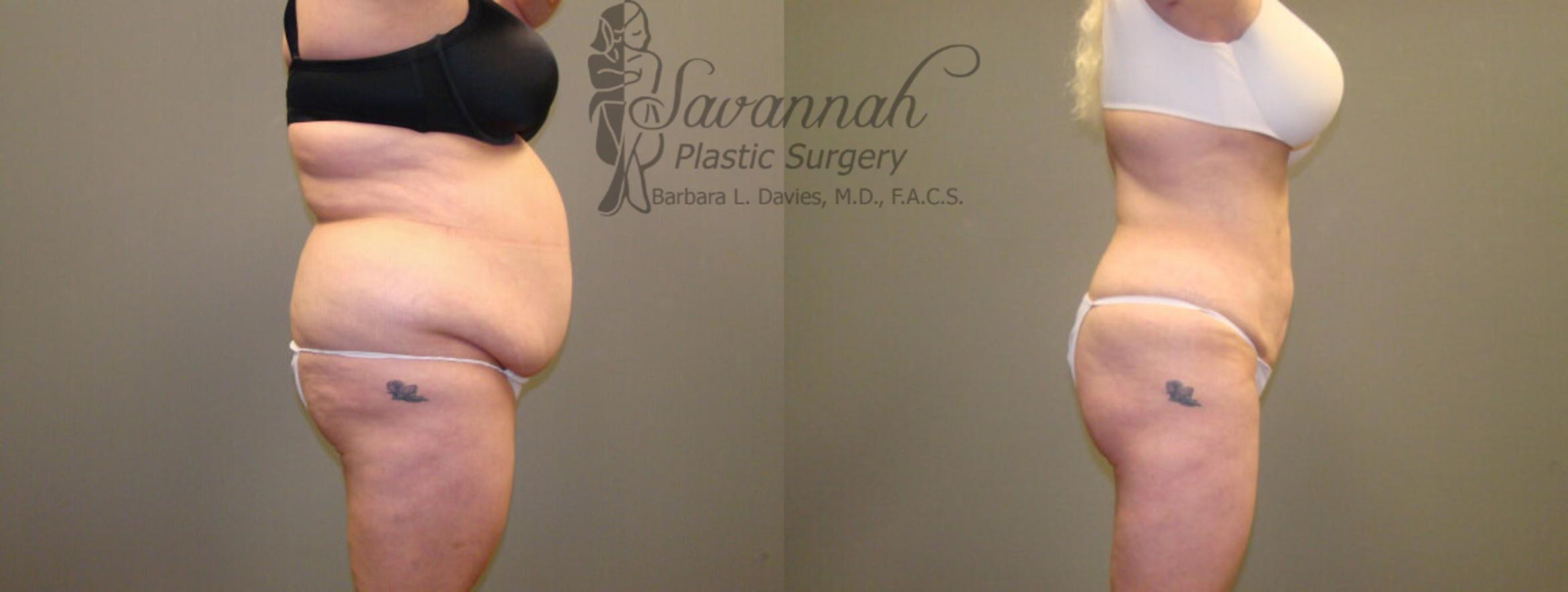 Before & After Liposuction Case 48 View 2 View in Savannah, Georgia