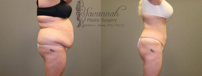 Before & After Liposuction Case 48 View 2 View in Savannah, Georgia