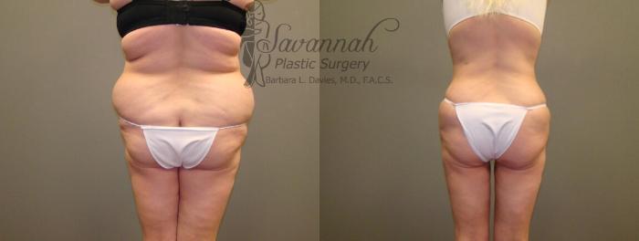 Before & After Liposuction Case 48 View 3 View in Savannah, Georgia