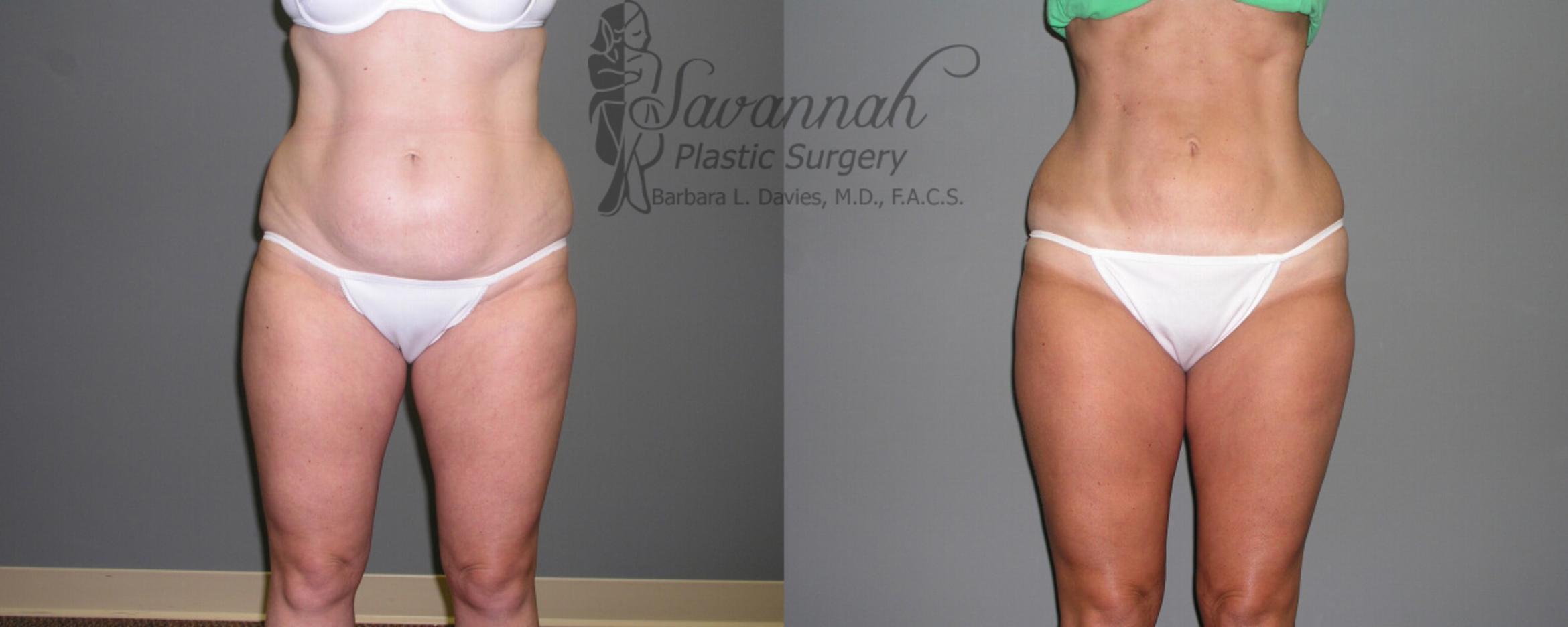Before & After Liposuction Case 49 View 1 View in Savannah, Georgia