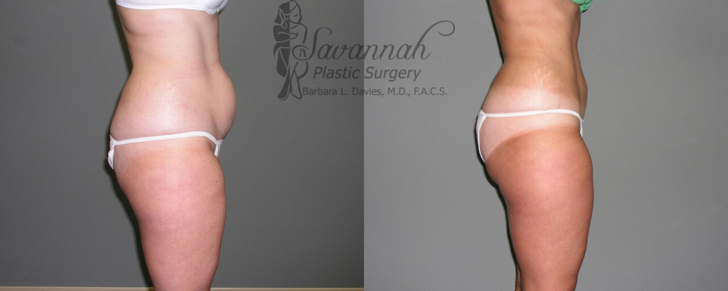 Before & After Liposuction Case 49 View 2 View in Savannah, Georgia