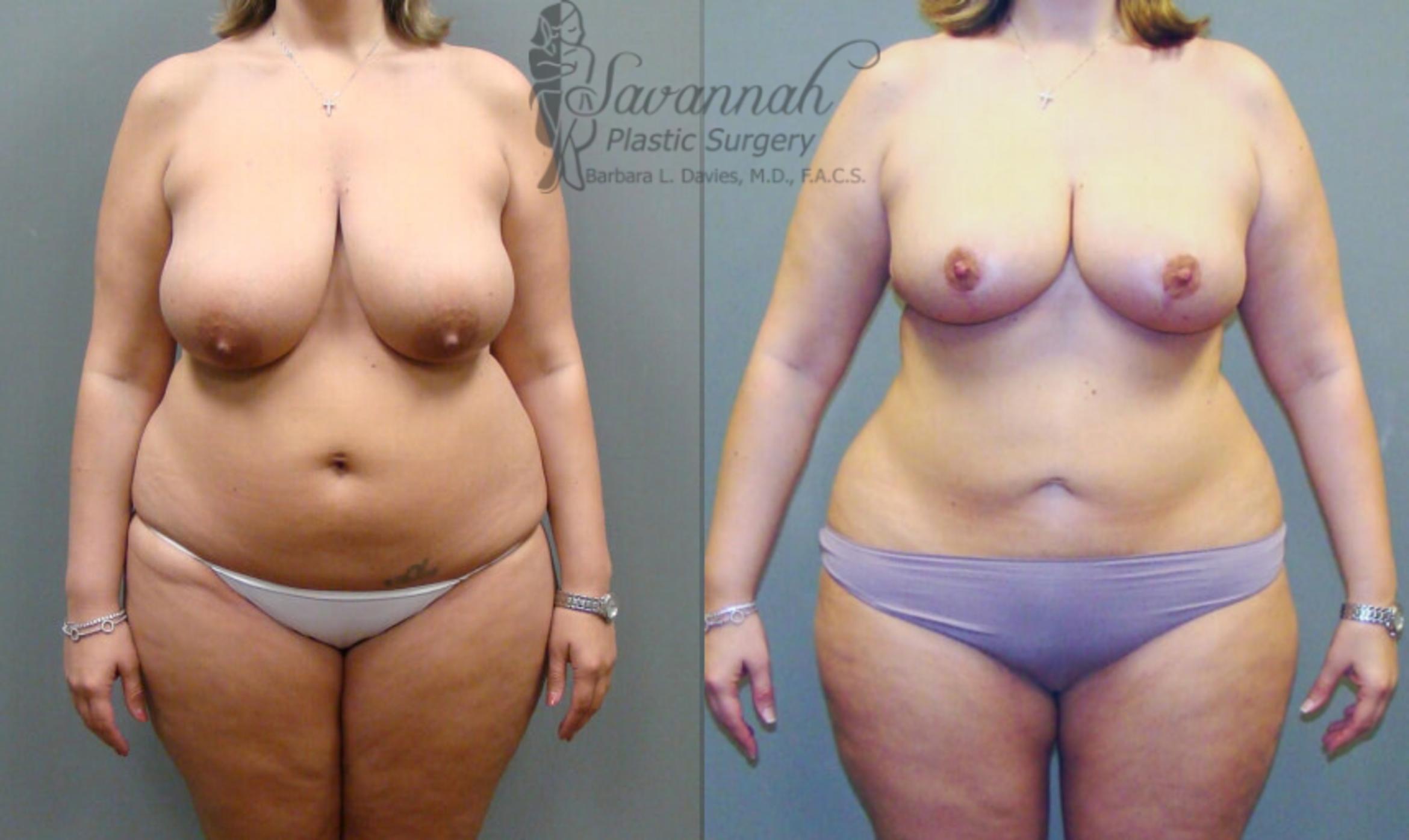 Before & After Liposuction Case 50 View 1 View in Savannah, Georgia