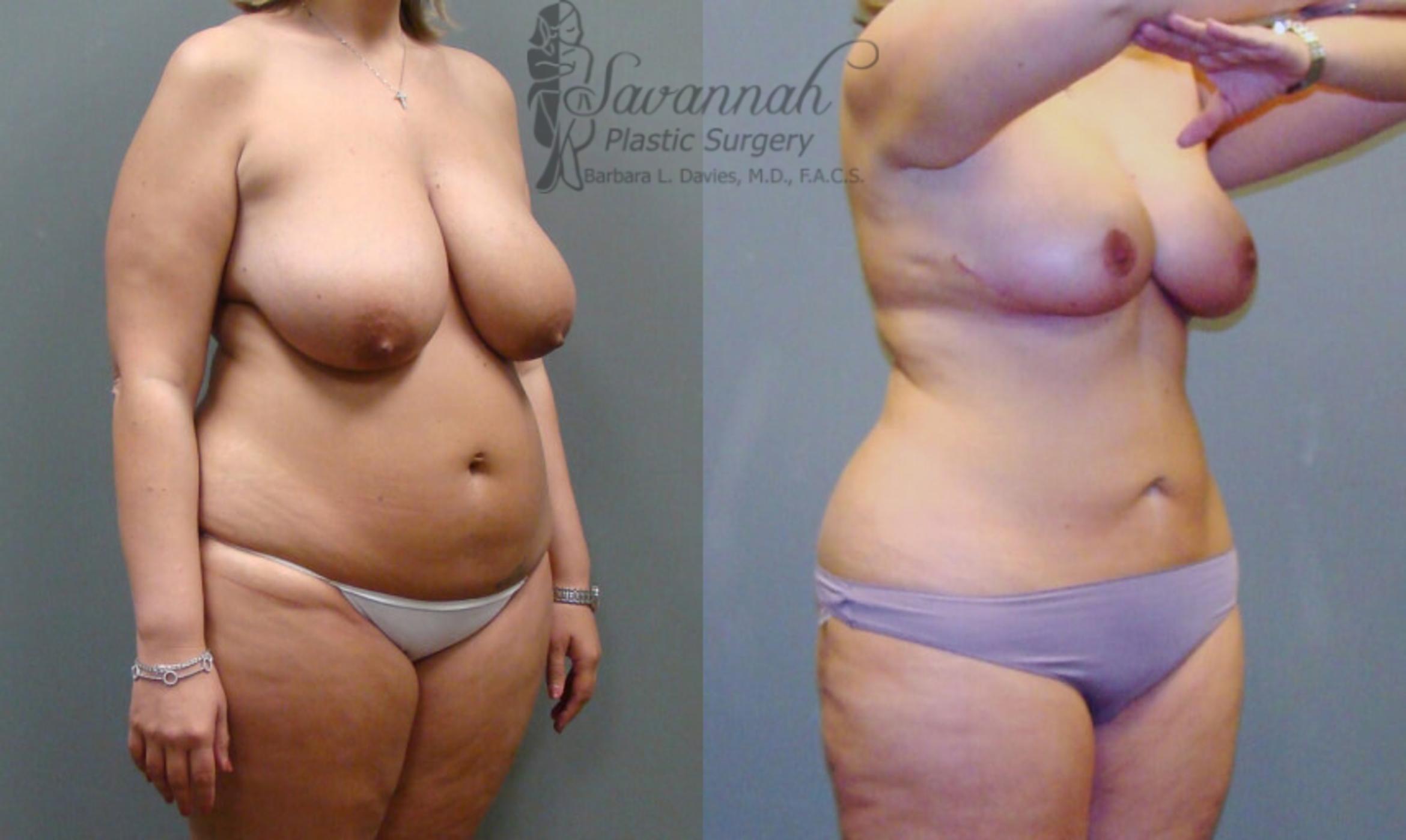 Before & After Liposuction Case 50 View 2 View in Savannah, Georgia