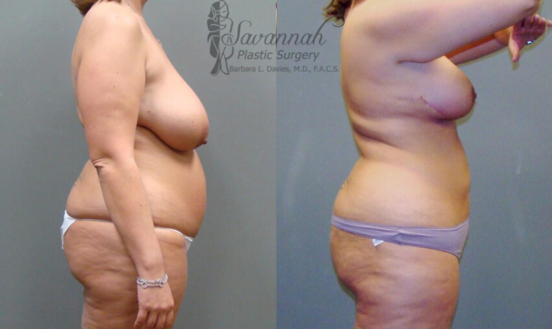 Before & After Liposuction Case 50 View 3 View in Savannah, Georgia