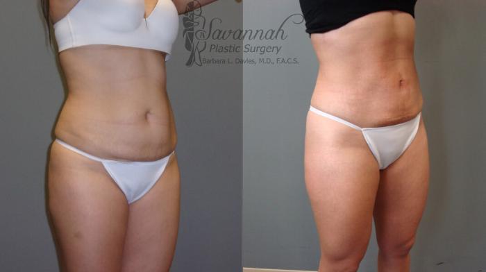 Before & After Liposuction Case 52 View 2 View in Savannah, Georgia