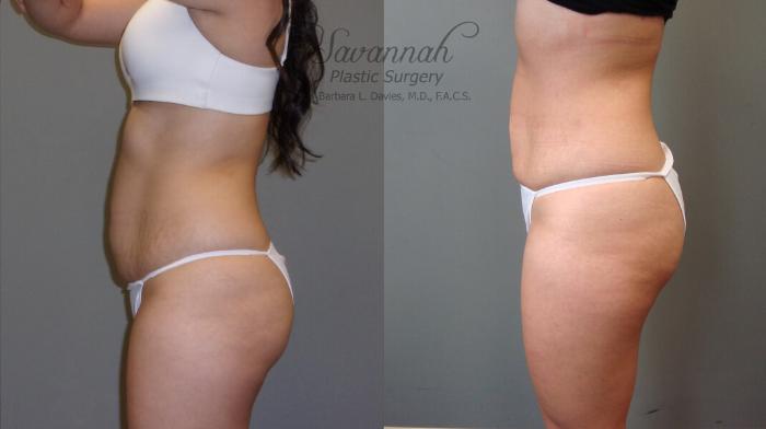 Before & After Liposuction Case 52 View 3 View in Savannah, Georgia