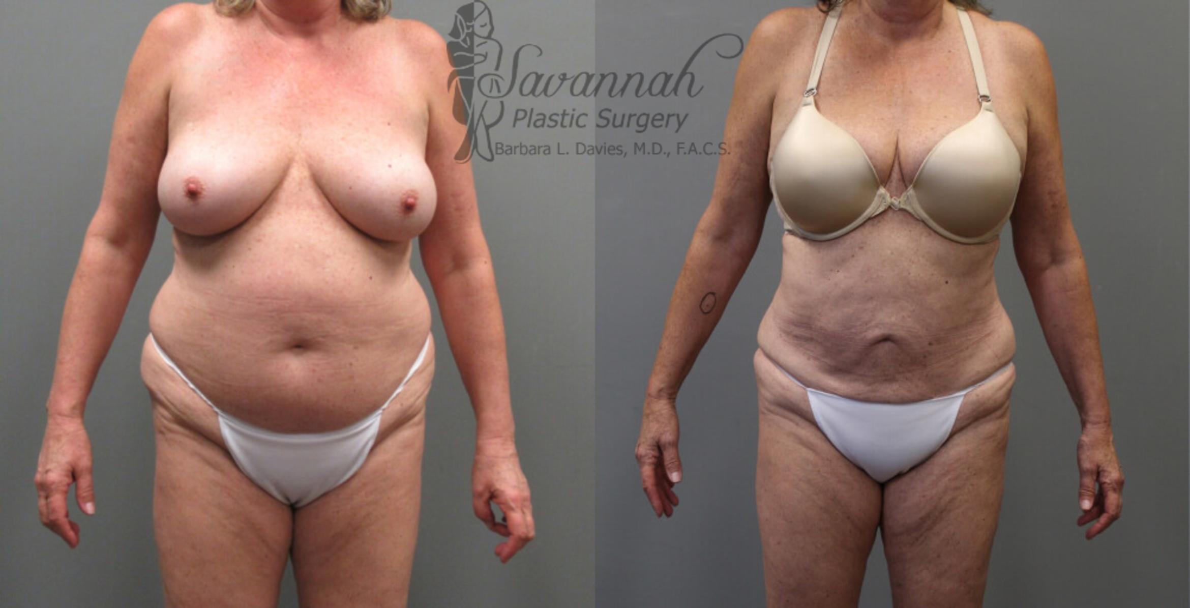 Before & After Liposuction Case 53 View 1 View in Savannah, Georgia