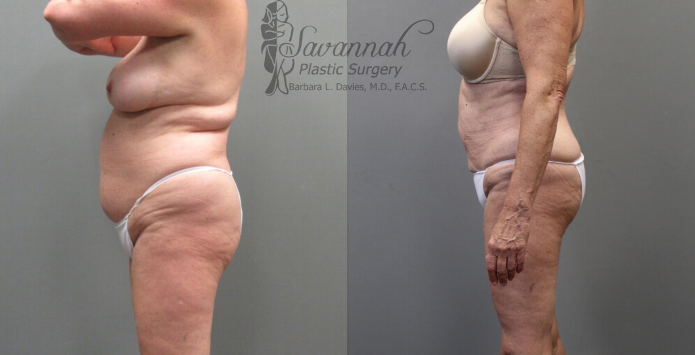 Before & After Liposuction Case 53 View 3 View in Savannah, Georgia