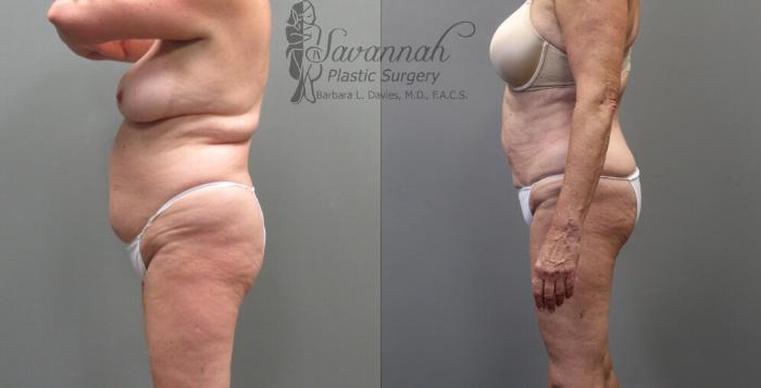 Before & After Liposuction Case 53 View 3 View in Savannah, Georgia