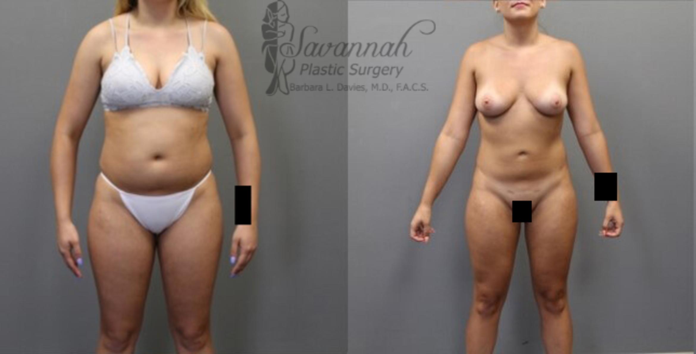 Before & After Liposuction Case 55 View 1 View in Savannah, Georgia