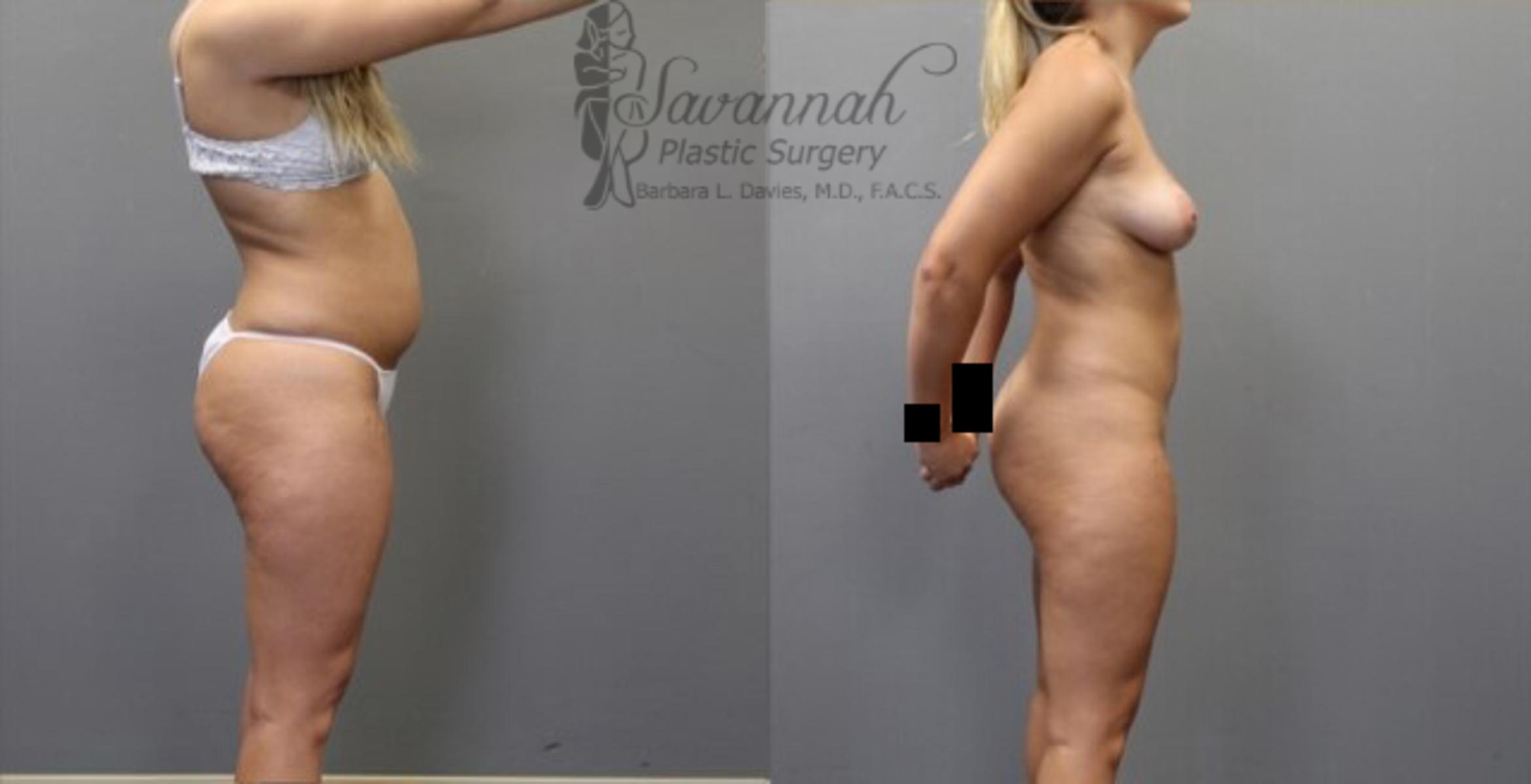 Before & After Liposuction Case 55 View 2 View in Savannah, Georgia