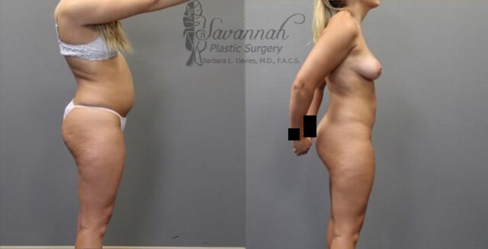Before & After Liposuction Case 55 View 2 View in Savannah, Georgia