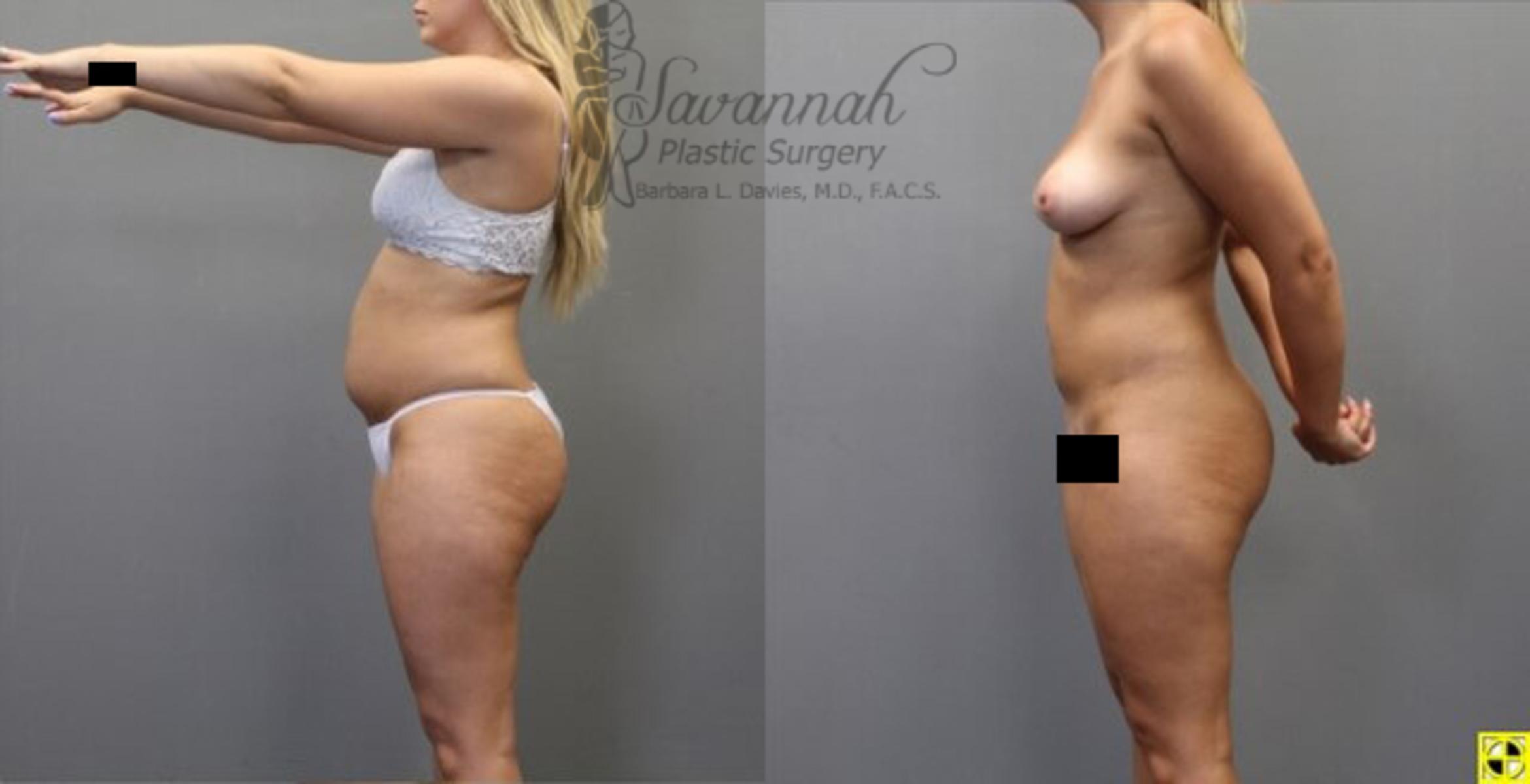 Before & After Liposuction Case 55 View 3 View in Savannah, Georgia