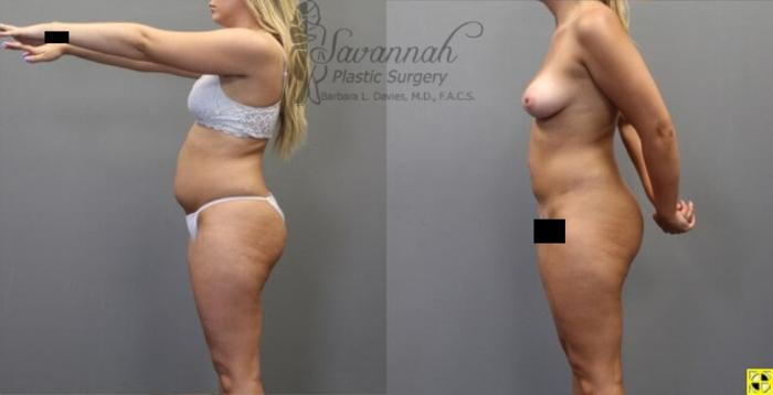 Before & After Liposuction Case 55 View 3 View in Savannah, Georgia