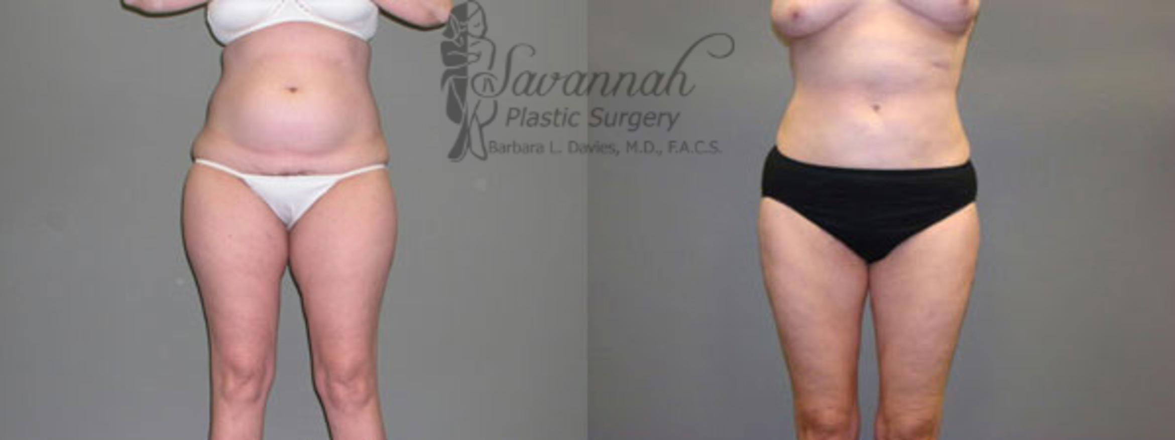 Before & After Liposuction Case 58 View 1 View in Savannah, Georgia